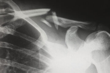 Slip and Fall Accidents